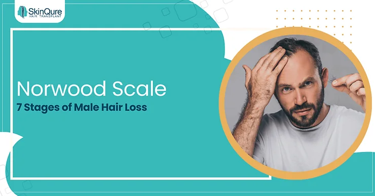 Norwood Scale: 7 Stages of Male Hair Loss - SkinQure, Delhi