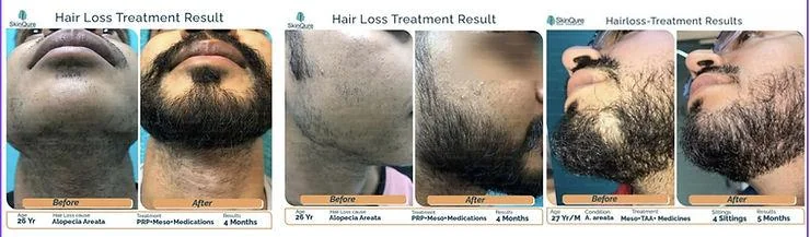 Patchy Beard: How to Handle it with a Beard Transplant? - SkinQure, Delhi
