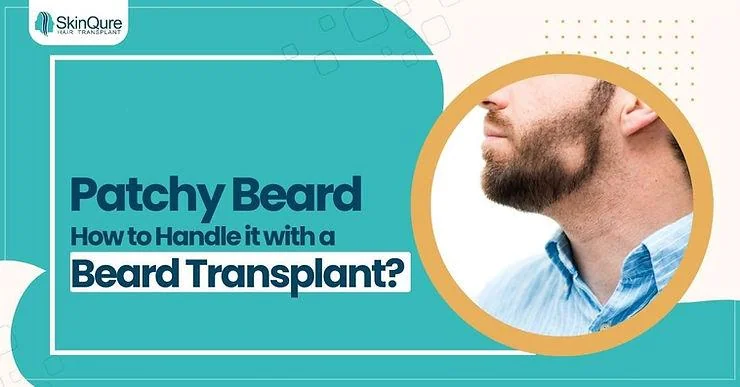 Patchy Beard: How to Handle it with a Beard Transplant? - SkinQure, Delhi