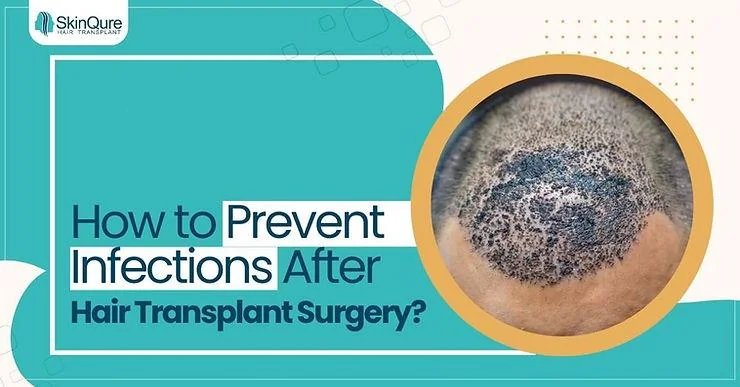 How to Prevent Infections After a Hair Transplant Surgery? - SkinQure, Delhi