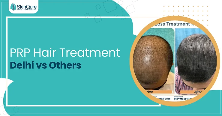 PRP Hair Treatment Delhi vs Others - SkinQure, Delhi