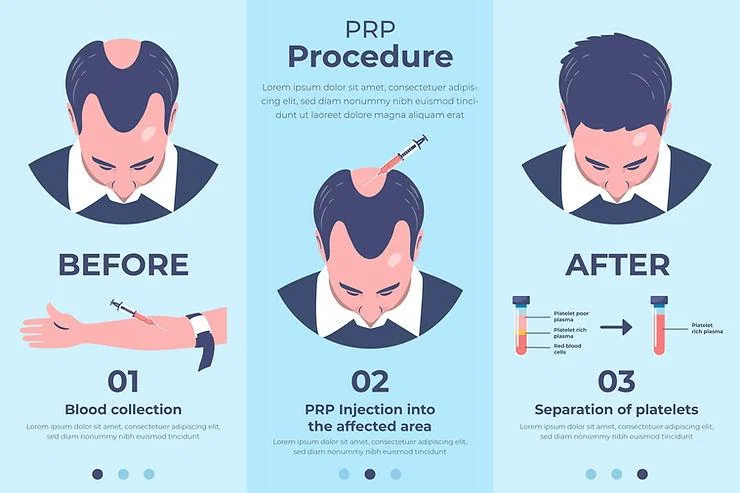 PRP Treatment in Delhi for Hair Fall: Sessions and Pricing - SkinQure, Delhi