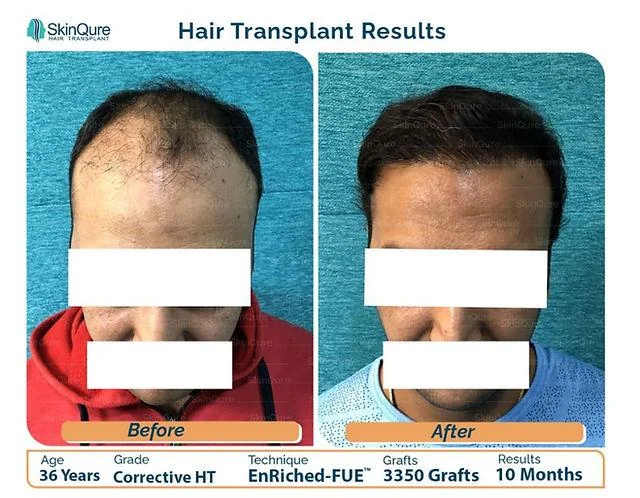 Everything You Must Know About Corrective Hair Transplant - SkinQure, Delhi