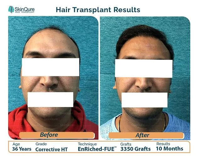 Everything You Must Know About Corrective Hair Transplant - SkinQure, Delhi