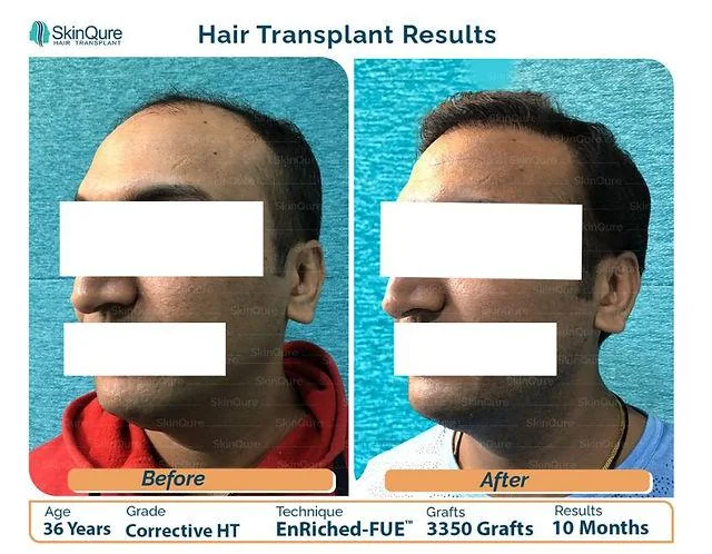 Everything You Must Know About Corrective Hair Transplant - SkinQure, Delhi