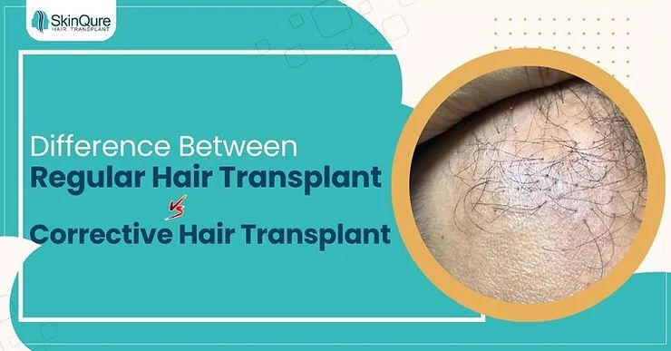 Difference between Regular Hair Transplant and Corrective Hair Transplant - SkinQure, Delhi