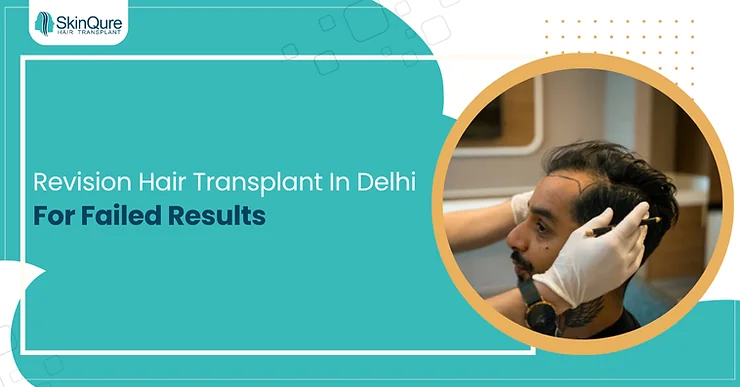 Revision Hair Transplant in Delhi for Failed Results - SkinQure, Delhi