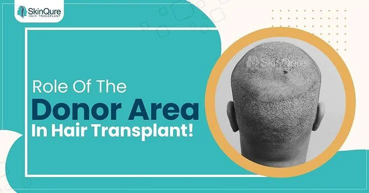 Role of the Donor Area in Achieving Natural Hair Transplant Results - SkinQure, Delhi