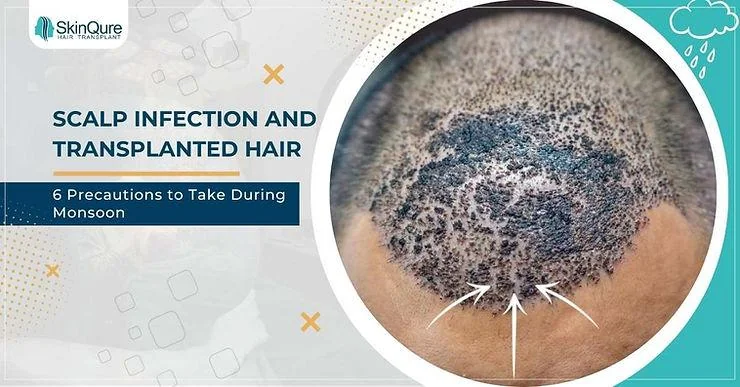 Scalp Infections and Transplanted Hair: 6 Precautions to Take During Monsoon - SkinQure, Delhi