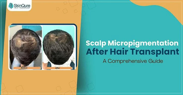 Scalp Micropigmentation After Hair Transplant: A Comprehensive Guide - SkinQure, Delhi