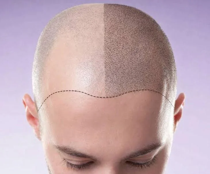 Scalp Micropigmentation Cost in Delhi: Full Guide - SkinQure, Delhi