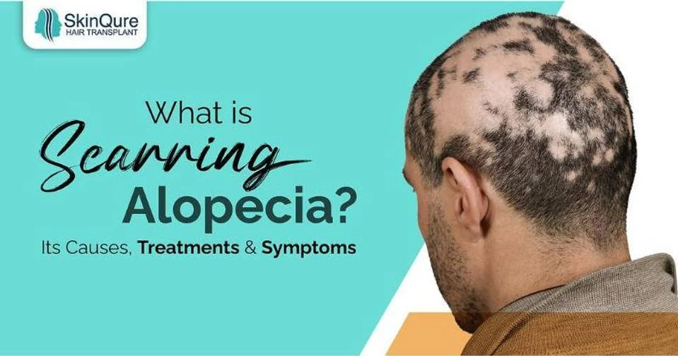 What is scarring alopecia - causes, treatments and symptoms - SkinQure, Delhi