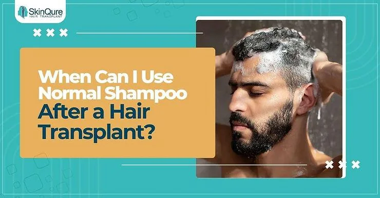 When Can I Use Normal Shampoo After a Hair Transplant? - SkinQure, Delhi