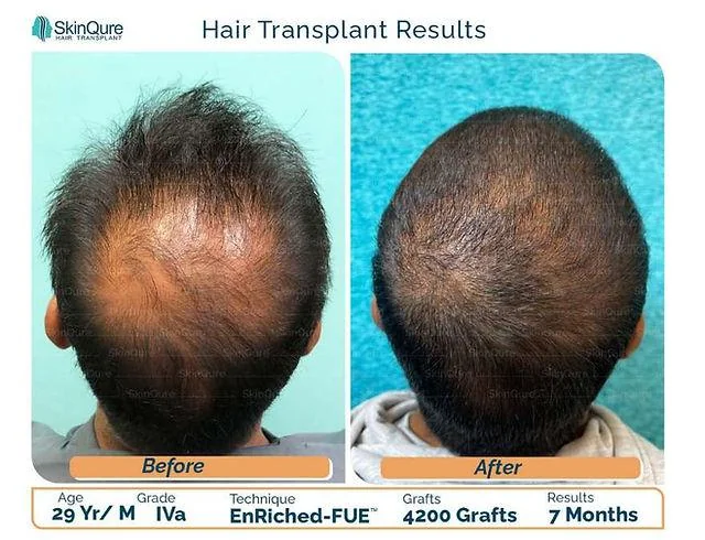 Stem Cell Hair Treatment India: Process & Cost 2026 - SkinQure, Delhi
