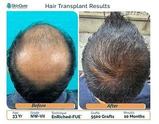 Stem Cell Hair Treatment India: Process & Cost 2026 - SkinQure, Delhi