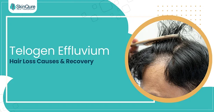 Telogen Effluvium: Hair Loss Causes & Recovery - SkinQure, Delhi