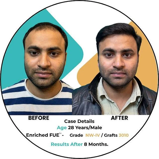 Rise of hair transplants among Indians - SkinQure, Delhi