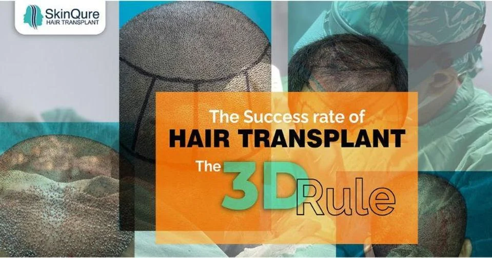 The success rate of hair transplant - the 3D Rule - SkinQure, Delhi