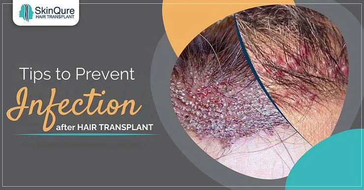 Best Tips to Prevent Infection After a Hair Transplant - SkinQure, Delhi
