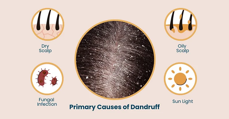 Can Wearing Hats Cause Dandruff in Winter? - SkinQure, Delhi