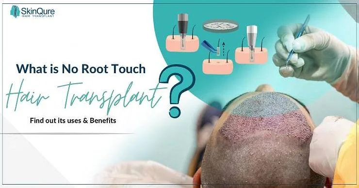 What is No Root Touch Hair Transplant? Find out its uses & Benefits - SkinQure, Delhi
