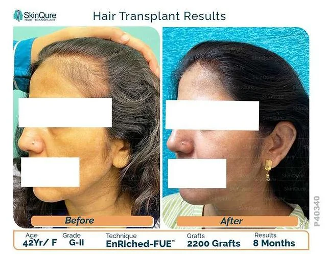 What Triggers Female Pattern Baldness? Treatment & Preventions - SkinQure, Delhi