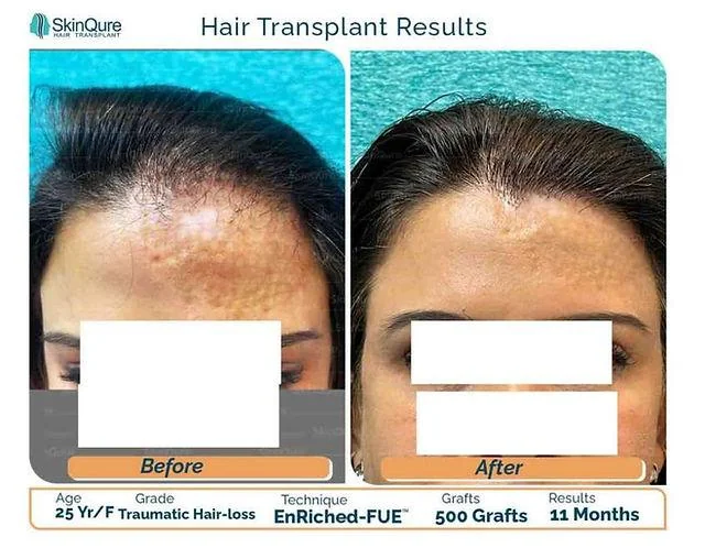 When Can Women Have a Hair Transplant? - SkinQure, Delhi