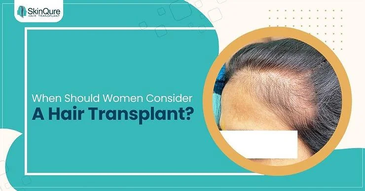 When Can Women Have a Hair Transplant? - SkinQure, Delhi