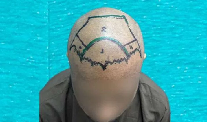 When Will I See Results After a Hair Transplant? - SkinQure, Delhi