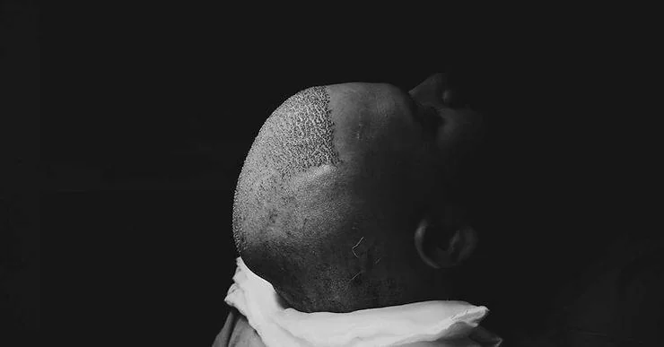 How to Sleep After Hair Transplant: Do’s and Don’ts - SkinQure, Delhi