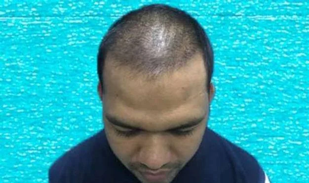 When Will I See Results After a Hair Transplant? - SkinQure, Delhi