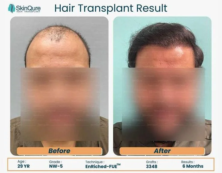 When Will I See Results After a Hair Transplant? - SkinQure, Delhi