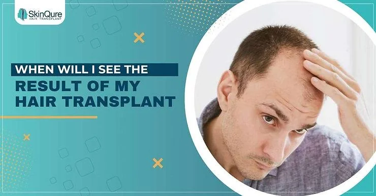 When Will I See Results After a Hair Transplant? - SkinQure, Delhi