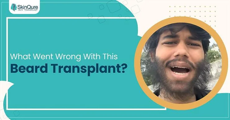 Why did the beard transplant go wrong? | Expert Insights - SkinQure, Delhi