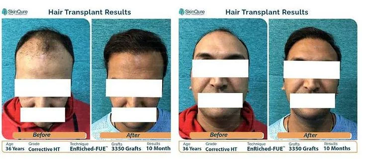 Why Do Some Hair Transplants Fail? - SkinQure, Delhi