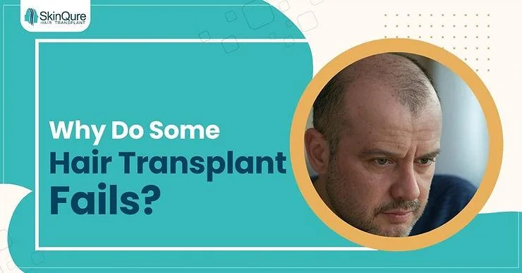 Why Do Some Hair Transplants Fail? - SkinQure, Delhi