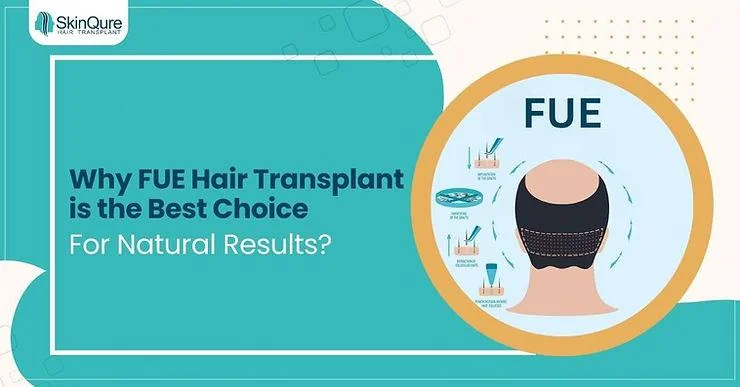 Why FUE Hair Transplant in Delhi is the Right Choice for Natural Hair Restoration - SkinQure, Delhi