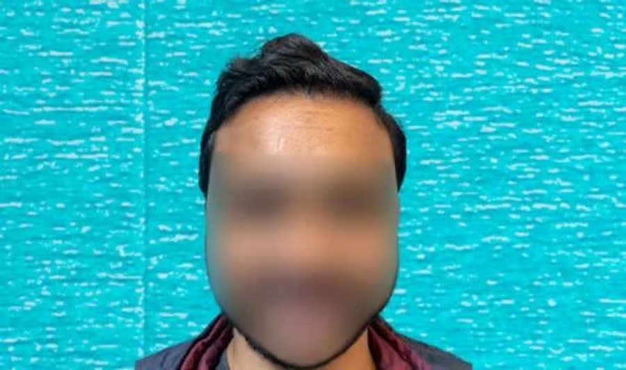 27-year-old male patient at his first hair loss consultation at SkinQure, Delhi