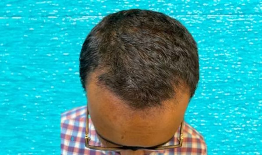 Before hair transplant: Norwood grade 3 hair loss at the hairline and mid-scalp