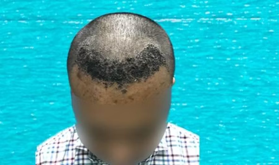 Scalp immediately after EnRiched-FUE hair transplant with 3,050 grafts implanted