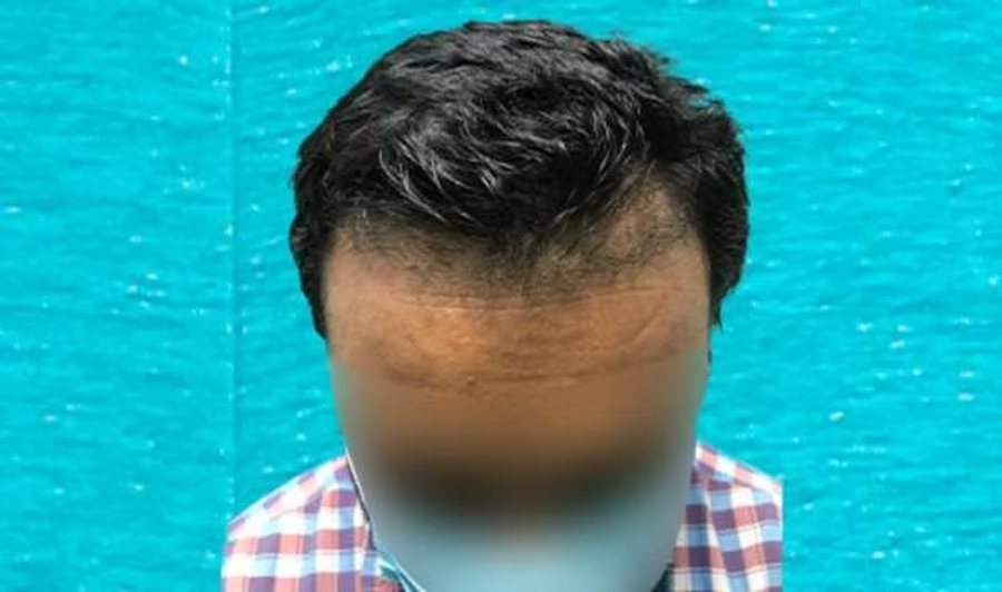Hair transplant result three months after surgery at SkinQure, Delhi