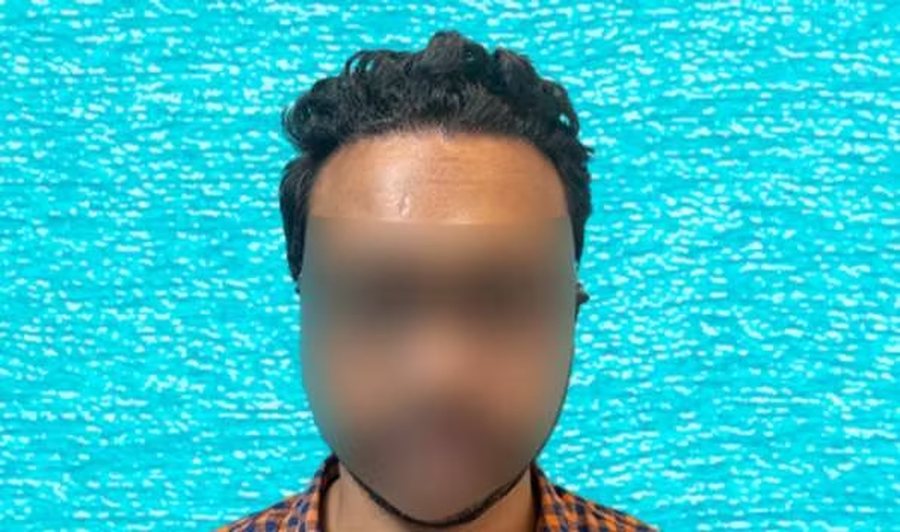 After hair transplant: restored hairline eight months after 3,050 grafts