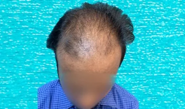 Before hair transplant: Norwood grade 4 hair loss across the front and mid-scalp