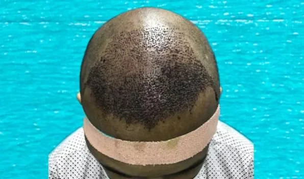 Donor area at the back of the scalp after FUE graft extraction, showing even harvesting