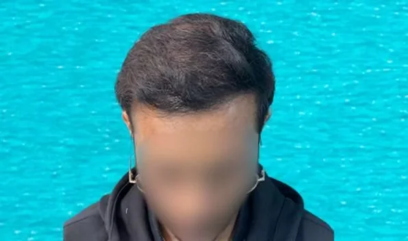 Hair transplant result seen from a second angle, showing density across the front and middle