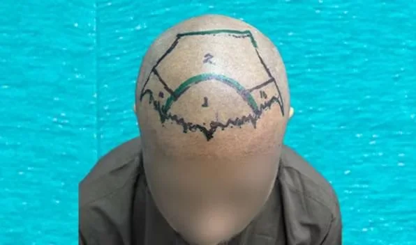Hairline design marked on the scalp before Bio-FUE hair transplant surgery