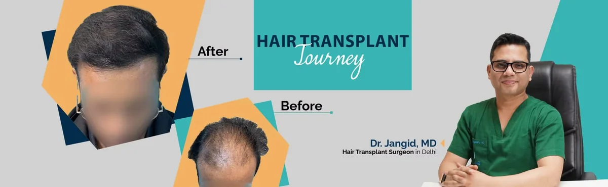 Hair transplant journey before and after by Dr. Jangid, hair transplant surgeon in Delhi