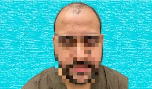 Before hair transplant: Norwood grade 5 hair loss, front view