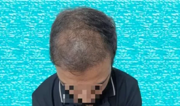 Top view before hair transplant showing Norwood grade 5 loss across the front, mid-scalp and crown