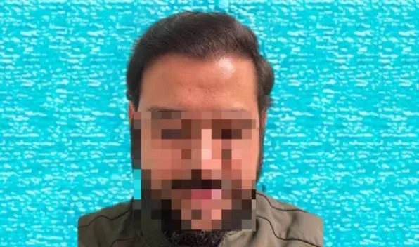 After hair transplant: restored hairline and coverage with 3780 grafts at eight months